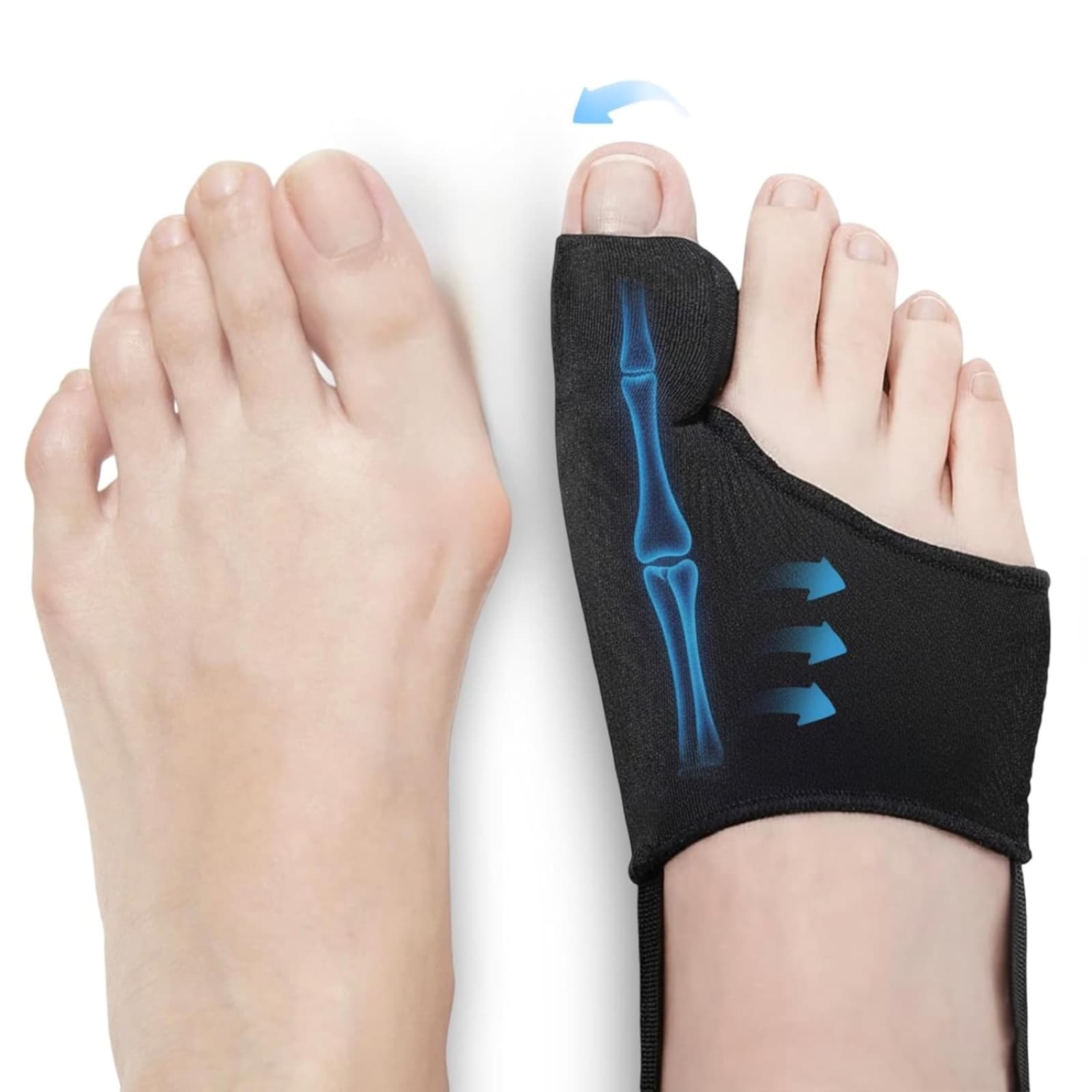 Vitella Bunion Corrector shown on a foot beside an untreated foot for comparison